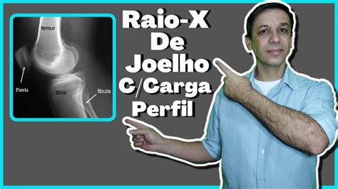 Como Realizar E Visualizar Um Raio X De Joelho Carga Em Perfil