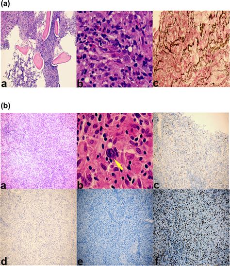 A Bone Marrow Biopsy A Bone Marrow Hematoxylin And Eosin Staining