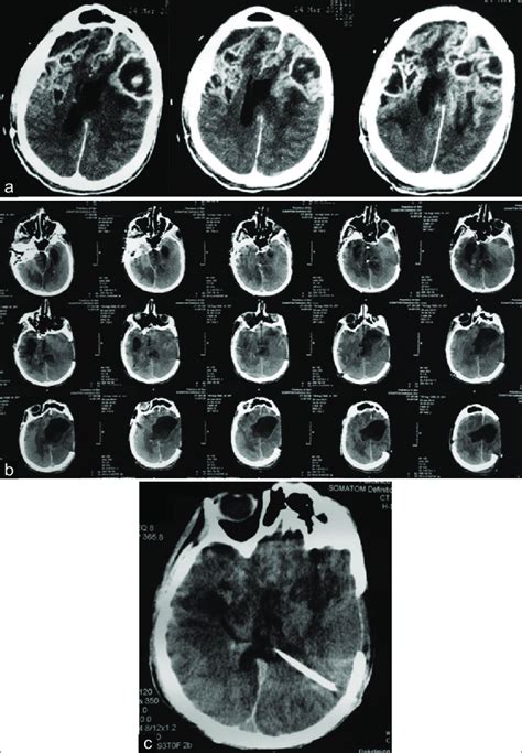 Following the first surgery, the patient developed signs of infection ...