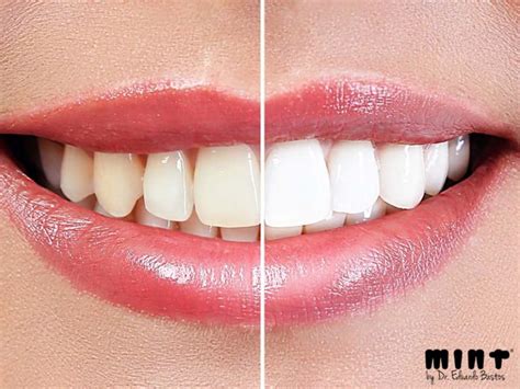 Como Branquear os Dentes 6 Técnicas Fáceis Clínica Dentária Mint