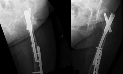 Post-operative radiographs showed the left hip fracture has well... | Download Scientific Diagram