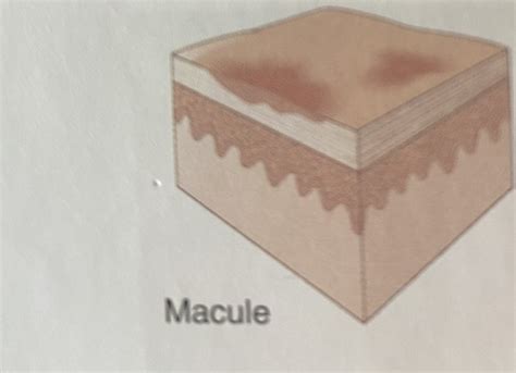 The Integumentary System Burns Flashcards Quizlet