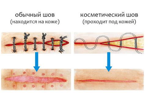 Послеоперационные швы: чем обрабатывать, снятие, заживление и лечение в ...
