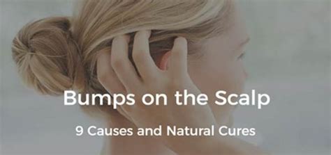 Bumps on Scalp: 9 Causes and Natural Treatments | Daily Health Cures