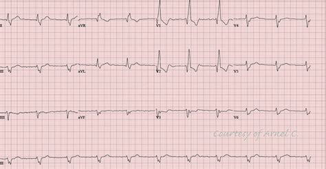 ECG Rhythms: Can atrial fibrillation (AF) be regular?