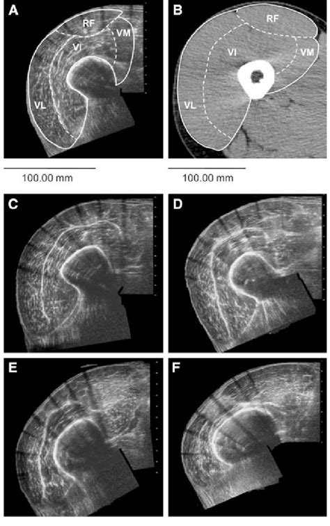 Axial Plane Images Of The Quadriceps Muscle Measured At The Section