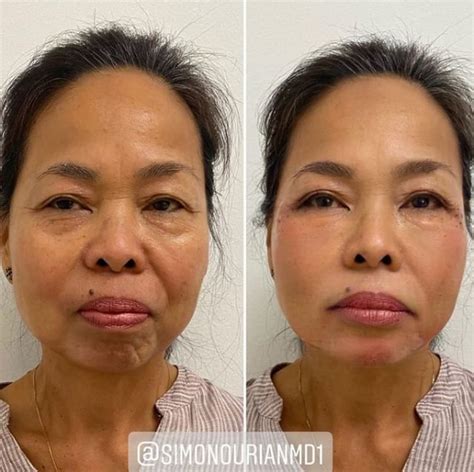 Non Surgical Facelift Before And After Photo Gallery Epione