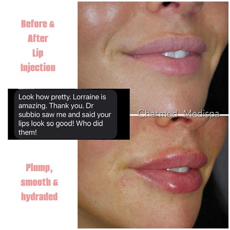 Lip Fillers – Charmed Medispa