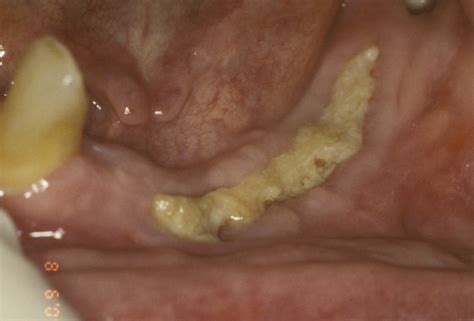 Osteoradionecrosis Of Jaw