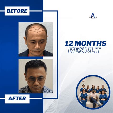 Lowering Hair Line Advanced Hair Transplant Specialist