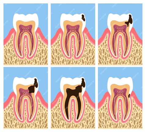 Anatomía Del Diente Con Fases De Caries Dental Vector Premium