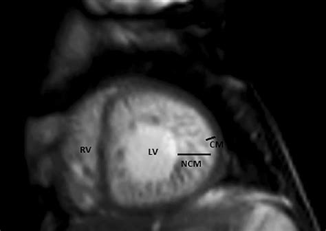 Cardiac Magnetic Resonance CMR Image Showing A Left Ventricular