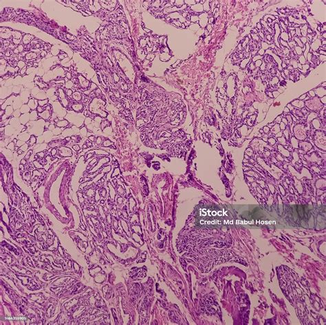 Eyelid Biopsy Lobular Capillary Hemangioma Smear Show Skin Benign Neoplasm Vessels With Rbc