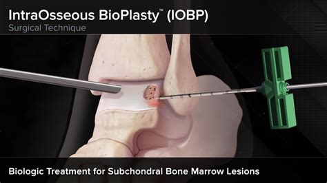 Arthrex Intraosseous Bioplasty Iobp Surgical Technique