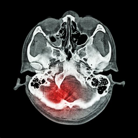 Adverse Side Effects of Eliquis Prompt Blood Thinner Lawsuit