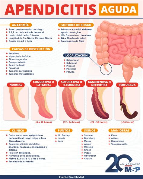 Apendicitis Aguda