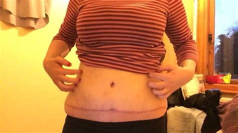 Tummy Tuck Abdominoplasty 3 Months Post Op Update Youtube