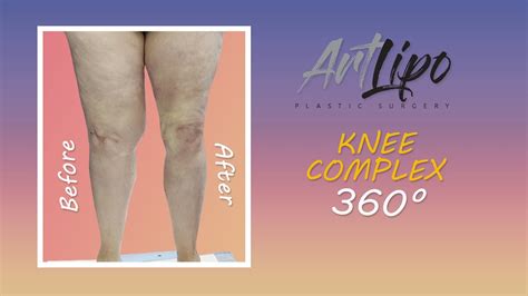 Lipedema Leg Liposuction Surgery Knee Complex Immediate Results