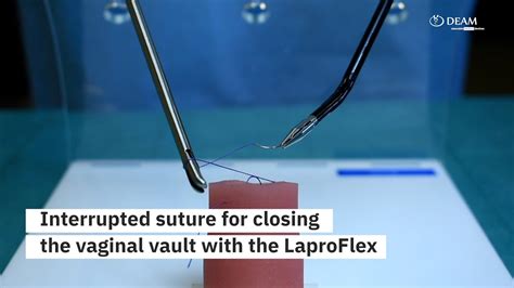 Interrupted Suture For Closure Of The Vaginal Vault In The DEAM