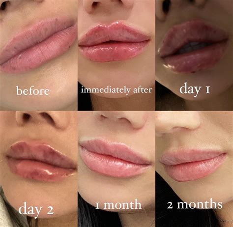 My Experience With The Russian Lip Filler R Plasticsurgery