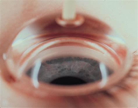 Congenital Glaucoma Clinical Tree