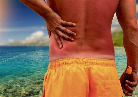 What Is The Best Treatment For Sunburn Advanced Dermatology And