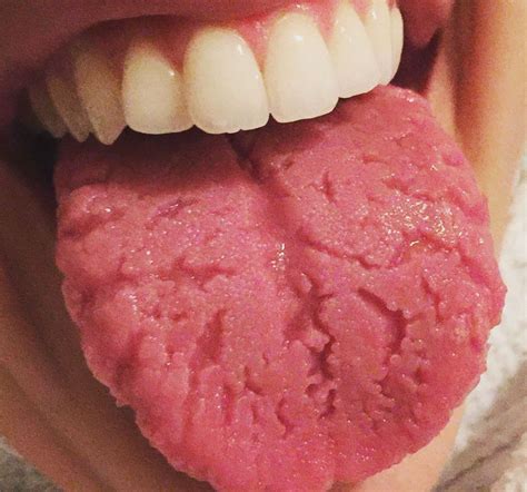 Fissured Tongue Medizzy