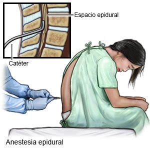 Anestesia Epidural Care Guide Information En Espanol