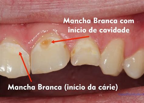 Cárie Ativa E Inativa - Cárie : tire todas suas dúvidas com nossa especialista