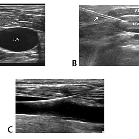 Cannulation Of The Right Internal Jugular Vein With Using Real Time Usg