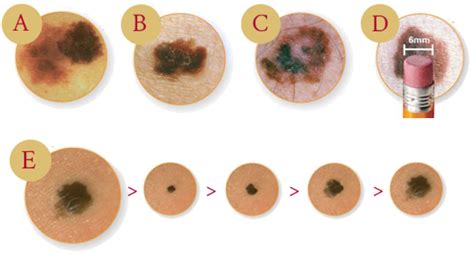 Full Body Skin Cancer Screenings