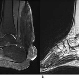 Sagittal sonogram of the Achilles tendon showing a heterogeneously ...