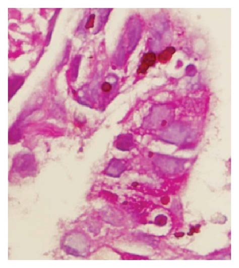 A Gastric Adenocarcinoma Papillary Growth Pattern B Gastric Tumor