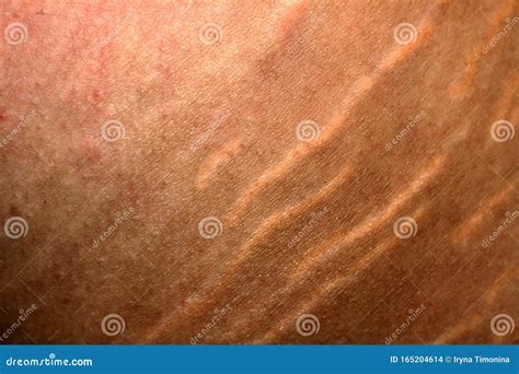 Stretch Marks On The Skin Scars On The Skin Stock Photo Image Of