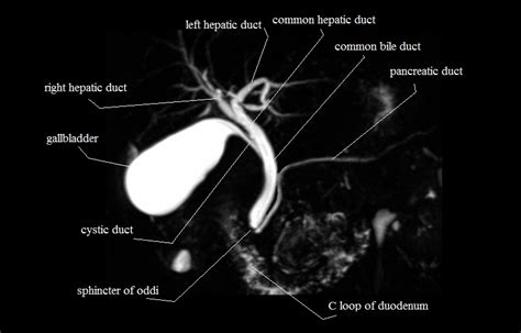 MRI MRCP Anatomy Free MRI Coronal Cross Sectional Anatomy Of The