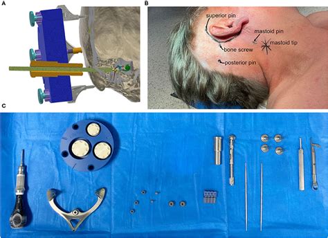 Frontiers Minimally Invasive Cochlear Implantation First In Man Of