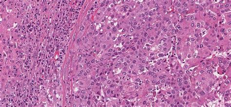 Hepatocellular carcinoma (HCC) - MyPathologyReport.ca