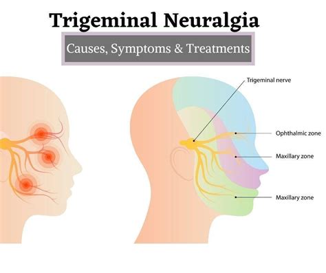 Trigeminal Neuralgia | The Prolotherapy Clinic, Pune