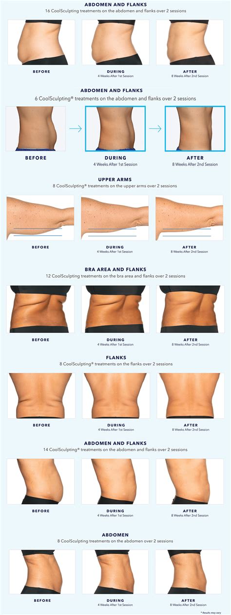 CoolSculpting Elite Before And After New Treatment Better Results