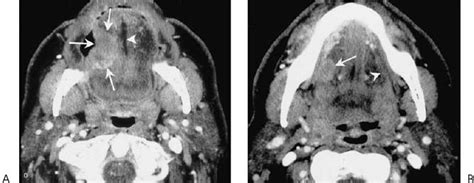 Submandibular Lymph Nodes Cancer Symptoms