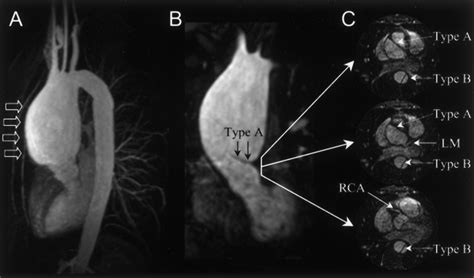 Aortic Dissection At The Coronary Artery Sinus Circulation