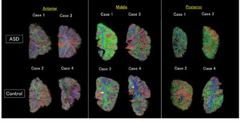 High Angular Resolution Diffusion Imaging HARDI Tractography The