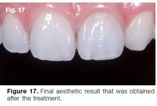 Calcific Metamorphosis A Review Of Literature And Clinical Management