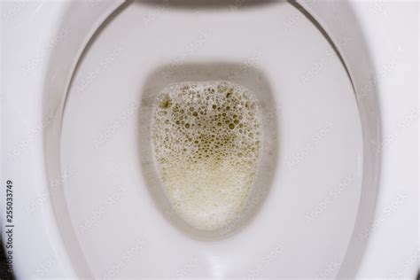 Frothy bubbly urine in the toilet bowl. Kidney disease. Protein. Stock ...