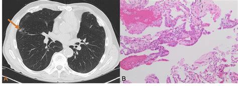 (A) CT scan showing a 2.8-cm ground glass opacity nodule in the right ...