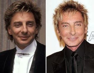 Barry Manilow Plastic Surgery Botox Injections Facelift Before And After