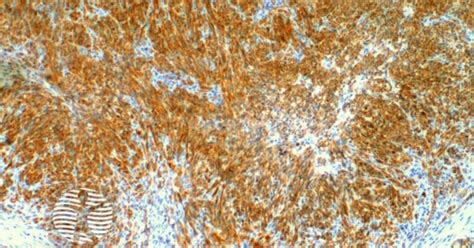 Dermnet® Kaposi Sarcoma Pathology Cd31 Stain Image