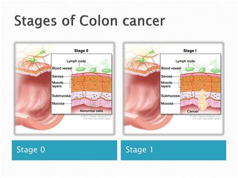 Colorectal Cancer Stages