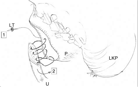 Retroperitoneoscopic Pyeloplasty For Ureteropelvic Junction Obstruction Upjo Solving The