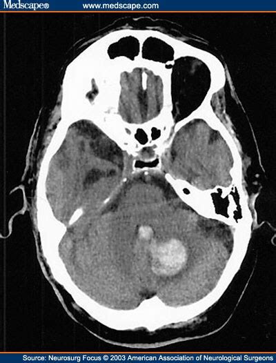 Spontaneous Intracerebral Hemorrhage A Review